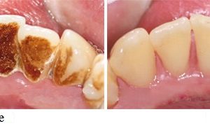 teeth-scaling